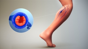 COVID-19 και θρόμβωση: απαραίτητη η επίσκεψη σας στον αγγειοχειρουργό