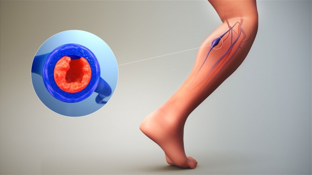 COVID-19 και θρόμβωση: απαραίτητη η επίσκεψη σας στον αγγειοχειρουργό